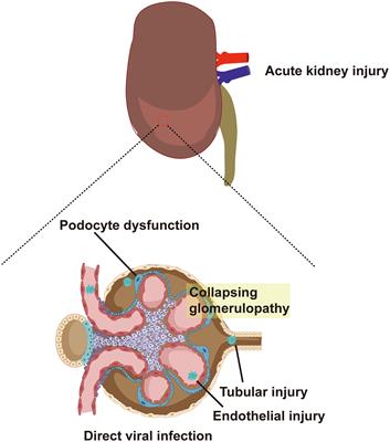 Mechanisms of SARS-CoV-2 Infection-Induced Kidney Injury: A Literature Review